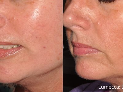 lumecca-before-after-dr-v-ross-preview-10